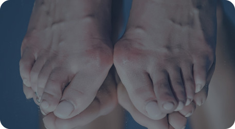 Hallux Valgus