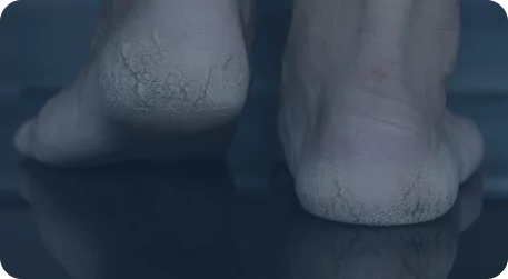Callosités, Cors, crevasses