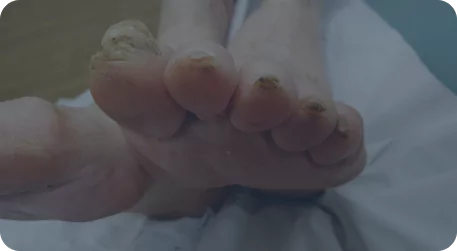Mycose de L’Ongle