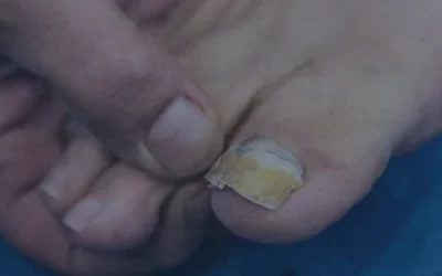 Ongle abîmé, cassant, décollé, épais