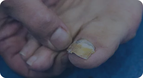 Ongle abîmé, cassant, décollé, épais