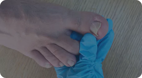 Ongle incarné